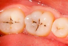 槽牙是指哪颗牙-槽牙拔掉了一定要种植牙吗